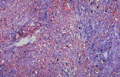 Lung Tissue with Crystalline SIlica Particles Embedded