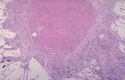 Typical whorled pattern in a silicotic nodule.